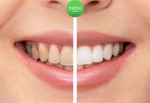 5 cách làm trắng răng tại nhà đơn giản không tốn tiền